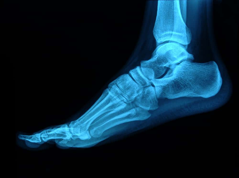 Ditch the Cast: Some Broken Ankles May Heal in Half the Time