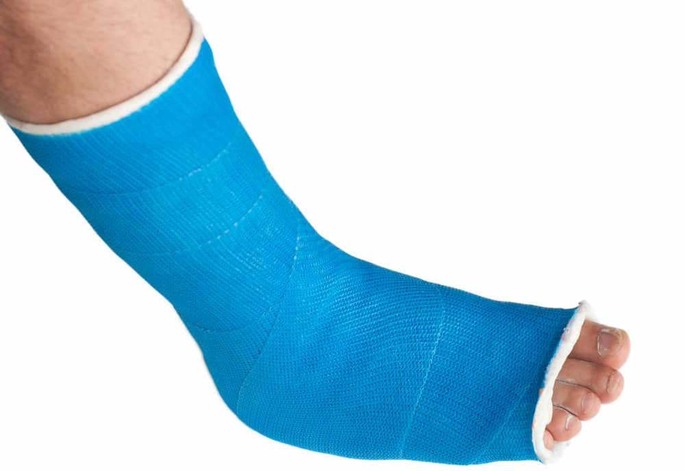 Ditch the Cast: Some Broken Ankles May Heal in Half the Time